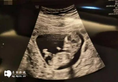 哪些原因会导致习惯性流产,这几类人不适合试管